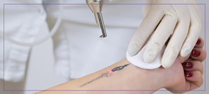 Picoway Laser Tattoo Removal Near Me in Dearborn, MI