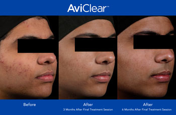 AviClear for Acne Treatment in Dearborn, MI