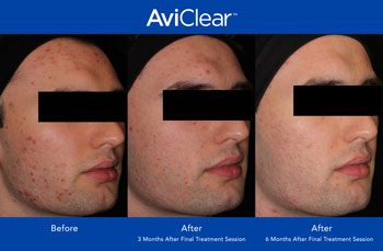 AviClear for Acne Treatment in Dearborn, MI