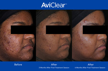 AviClear for Acne Treatment in Dearborn, MI