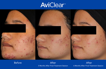 AviClear for Acne Treatment in Dearborn, MI