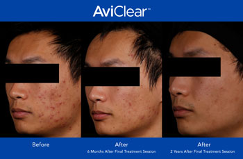 AviClear for Acne Treatment in Dearborn, MI