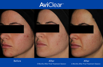 AviClear for Acne Treatment in Dearborn, MI