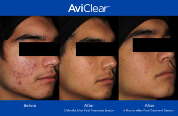 AviClear for Acne Treatment in Dearborn, MI