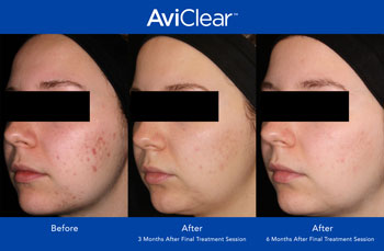 AviClear for Acne Treatment in Dearborn, MI