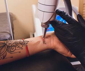 Picoway Laser Tattoo Removal Near Me in Dearborn, MI