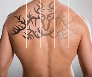 Picoway Laser Tattoo Removal Near Me in Dearborn, MI