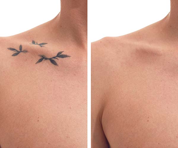 Picoway Laser Tattoo Removal Near Me in Dearborn, MI