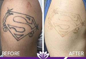 PicoWay Laser Tattoo Removal in Dearborn, MI