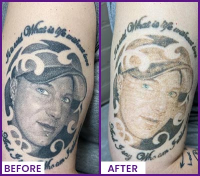 Picoway Laser Tattoo Removal Specialist Near Me in Dearborn, MI