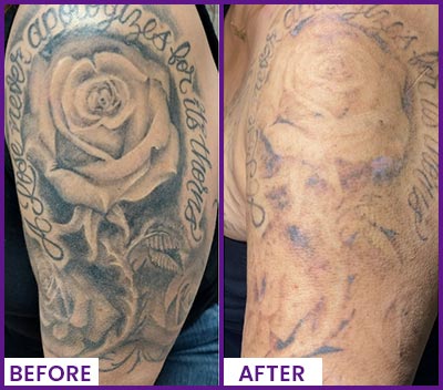 Picoway Laser Tattoo Removal Specialist Near Me in Dearborn, MI