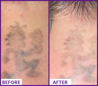 Picoway Laser Tattoo Removal Specialist Near Me in Dearborn, MI