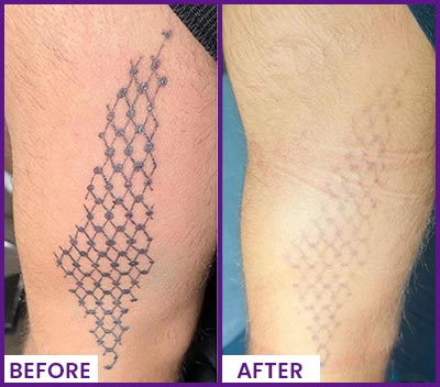 Picoway Laser Tattoo Removal Specialist Near Me in Dearborn, MI