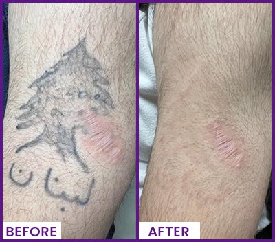 Picoway Laser Tattoo Removal Specialist Near Me in Dearborn, MI