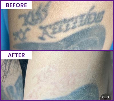 Picoway Laser Tattoo Removal Specialist Near Me in Dearborn, MI