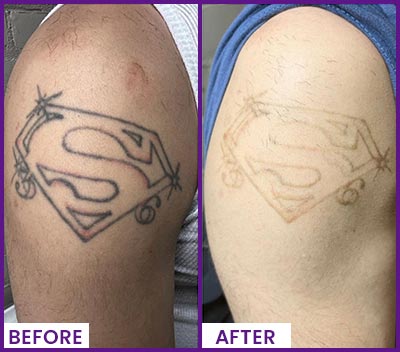 Picoway Laser Tattoo Removal Specialist Near Me in Dearborn, MI