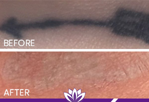 PicoWay Laser Tattoo Removal in Dearborn, MI