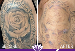 PicoWay Laser Tattoo Removal in Dearborn, MI