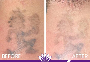 PicoWay Laser Tattoo Removal in Dearborn, MI