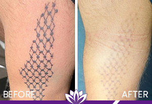 PicoWay Laser Tattoo Removal in Dearborn, MI