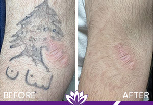 PicoWay Laser Tattoo Removal in Dearborn, MI