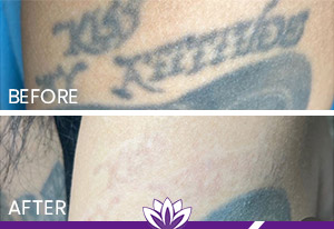 PicoWay Laser Tattoo Removal in Dearborn, MI