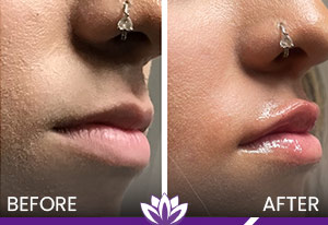 Lip Filler Before and After Photos of Clients at Laser Duet Med Spa in Dearborn, MI
