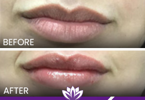 Lip Filler Before and After Photos of Clients at Laser Duet Med Spa in Dearborn, MI