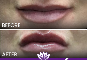 Lip Filler Before and After Photos of Clients at Laser Duet Med Spa in Dearborn, MI