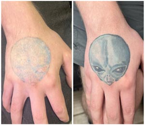 PicoWay Laser Tattoo Removal Before and After Photos of Clients at Laser Duet Med Spa in Dearborn, MI