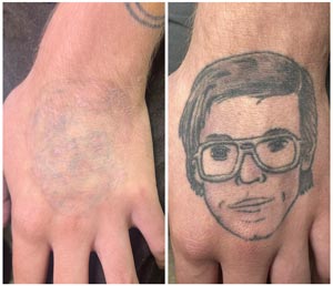 PicoWay Laser Tattoo Removal Before and After Photos of Clients at Laser Duet Med Spa in Dearborn, MI