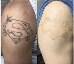 PicoWay Laser Tattoo Removal Before and After Photos of Clients at Laser Duet Med Spa in Dearborn, MI PicoWay Laser Tattoo Removal Before and After Photos of Clients at Laser Duet Med Spa in Dearborn, MI