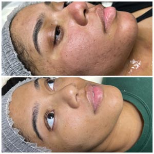 Morpheus8 Before and After Photos of Clients at Laser Duet Med Spa in Dearborn, MI Morpheus8 Before and After Photos of Clients at Laser Duet Med Spa in Dearborn, MI