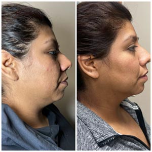 Morpheus8 Before and After Photos of Clients at Laser Duet Med Spa in Dearborn, MI Morpheus8 Before and After Photos of Clients at Laser Duet Med Spa in Dearborn, MI