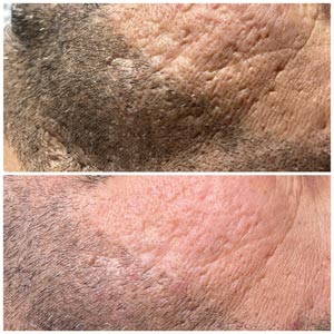 Morpheus8 Before and After Photos of Clients at Laser Duet Med Spa in Dearborn, MI Morpheus8 Before and After Photos of Clients at Laser Duet Med Spa in Dearborn, MI