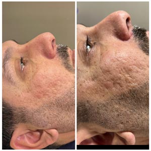 Morpheus8 Before and After Photos of Clients at Laser Duet Med Spa in Dearborn, MI Morpheus8 Before and After Photos of Clients at Laser Duet Med Spa in Dearborn, MI