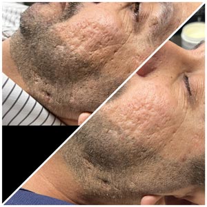 Morpheus8 Before and After Photos of Clients at Laser Duet Med Spa in Dearborn, MI Morpheus8 Before and After Photos of Clients at Laser Duet Med Spa in Dearborn, MI