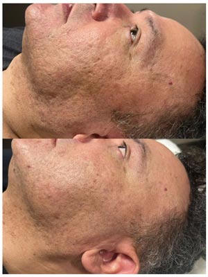 PicoWay Laser Treatment Before and After Photos of Clients at Laser Duet Med Spa in Dearborn, MI PicoWay Laser Treatment Before and After Photos of Clients at Laser Duet Med Spa in Dearborn, MI