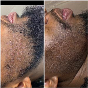 PicoWay Laser Treatment Before and After Photos of Clients at Laser Duet Med Spa in Dearborn, MI PicoWay Laser Treatment Before and After Photos of Clients at Laser Duet Med Spa in Dearborn, MI