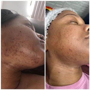 PicoWay Laser Treatment Before and After Photos of Clients at Laser Duet Med Spa in Dearborn, MI PicoWay Laser Treatment Before and After Photos of Clients at Laser Duet Med Spa in Dearborn, MI