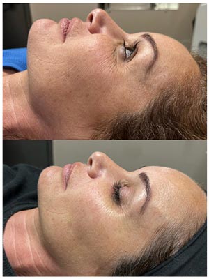 PicoWay Laser Treatment Before and After Photos of Clients at Laser Duet Med Spa in Dearborn, MI PicoWay Laser Treatment Before and After Photos of Clients at Laser Duet Med Spa in Dearborn, MI