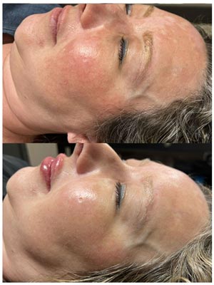 PicoWay Laser Treatment Before and After Photos of Clients at Laser Duet Med Spa in Dearborn, MI PicoWay Laser Treatment Before and After Photos of Clients at Laser Duet Med Spa in Dearborn, MI