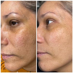 PicoWay Laser Treatment Before and After Photos of Clients at Laser Duet Med Spa in Dearborn, MI PicoWay Laser Treatment Before and After Photos of Clients at Laser Duet Med Spa in Dearborn, MI