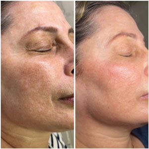 PicoWay Laser Treatment Before and After Photos of Clients at Laser Duet Med Spa in Dearborn, MI PicoWay Laser Treatment Before and After Photos of Clients at Laser Duet Med Spa in Dearborn, MI