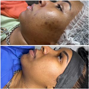 PicoWay Laser Treatment Before and After Photos of Clients at Laser Duet Med Spa in Dearborn, MI PicoWay Laser Treatment Before and After Photos of Clients at Laser Duet Med Spa in Dearborn, MI