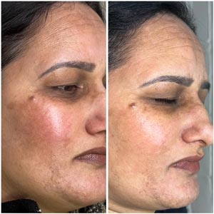 PicoWay Laser Treatment Before and After Photos of Clients at Laser Duet Med Spa in Dearborn, MI PicoWay Laser Treatment Before and After Photos of Clients at Laser Duet Med Spa in Dearborn, MI