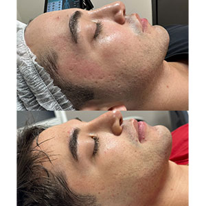 Morpheus8 Before and After Photos of Clients at Laser Duet Med Spa in Dearborn, MI Morpheus8 Before and After Photos of Clients at Laser Duet Med Spa in Dearborn, MI