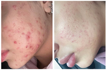 AviClear for Acne Treatment Before and After Photos of Clients at Laser Duet Med Spa in Dearborn, MI