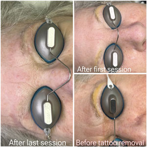 Eyebrow Tattoo Removal Before and After Photos of Clients at Laser Duet Med Spa in Dearborn, MI