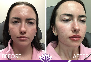 Lip Filler Before and After Photos of Clients at Laser Duet Med Spa in Dearborn, MI